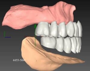 DIGITAL-DENTURE